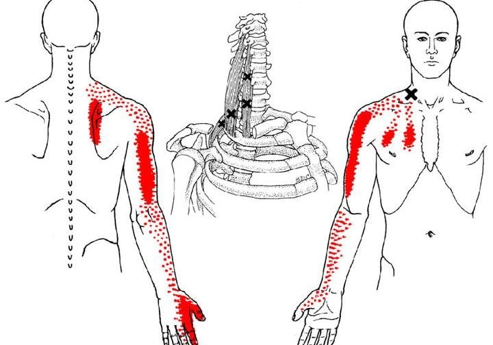 Unlocking the Mind-Body Connection: Healing Radiating Pain Points